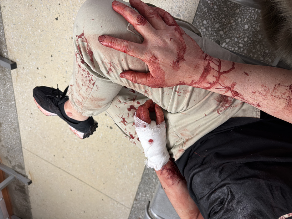 Injured person with bandaged hand observed in Ust-Ilimsk, Russia