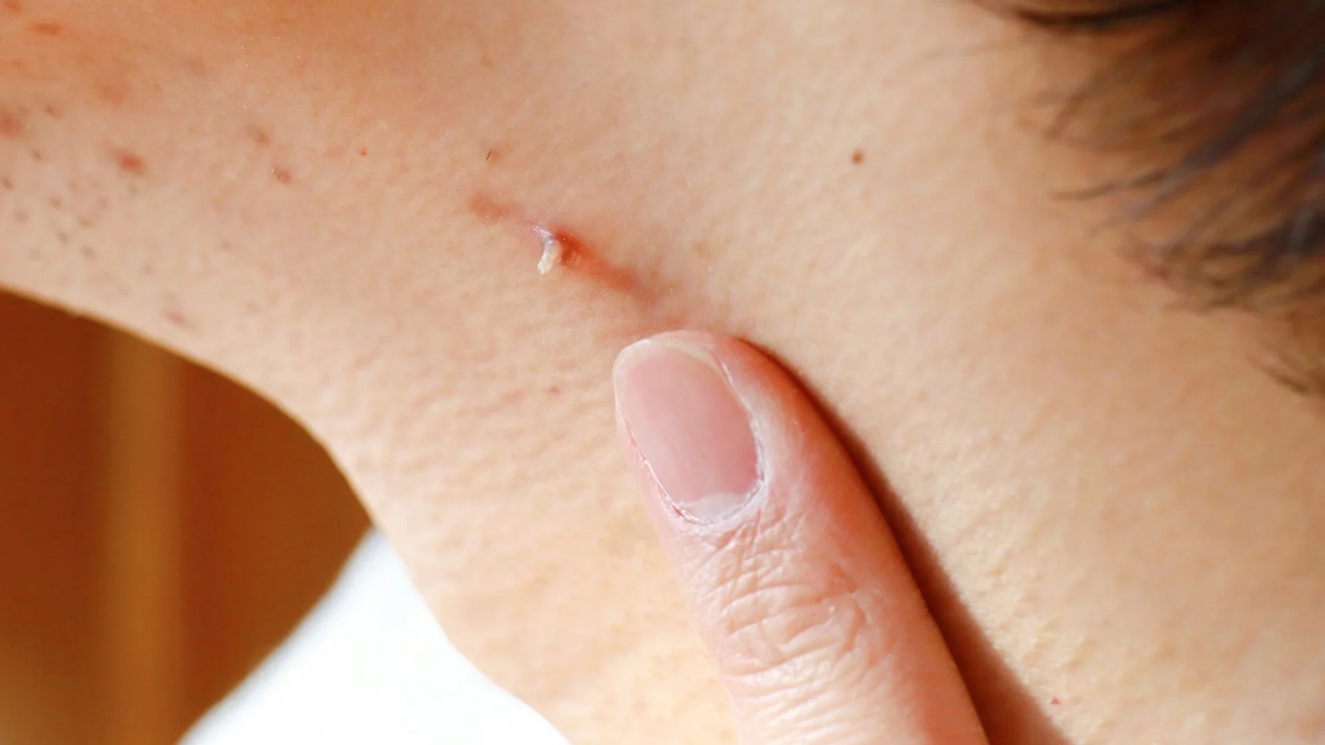 Pozbądź się brodawek i brodawczaków w tydzień: 5-minutowy przepis, który wykonasz w domu