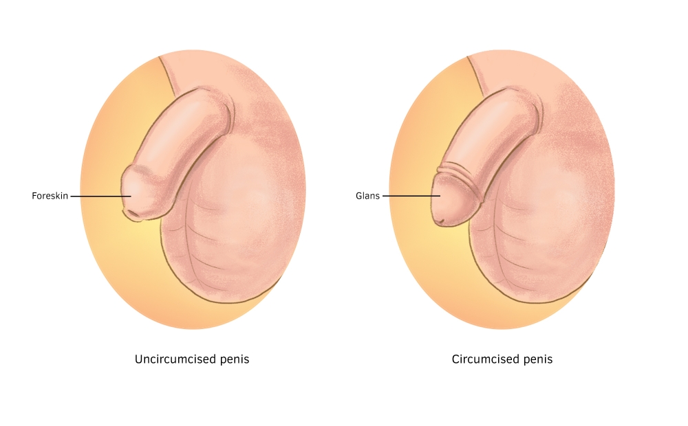 In a circumcised penis, the foreskin is removed, exposing the glans.