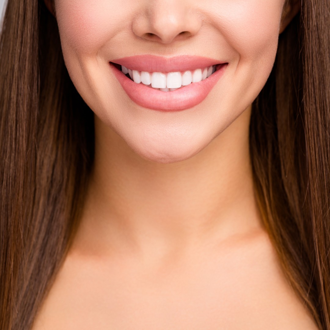 Can I Eat or Drink Normally After Getting Composite Veneers?