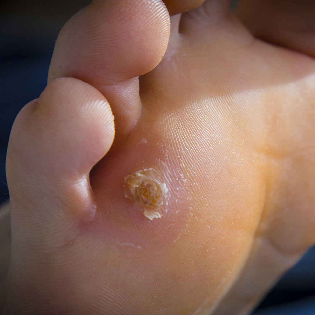 What Are Effective Treatments for Corns and Calluses?