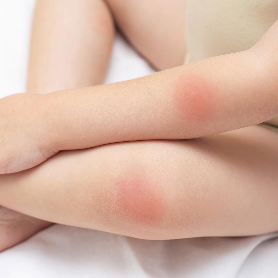 Are There Home Remedies for Bug Bites & Stings?