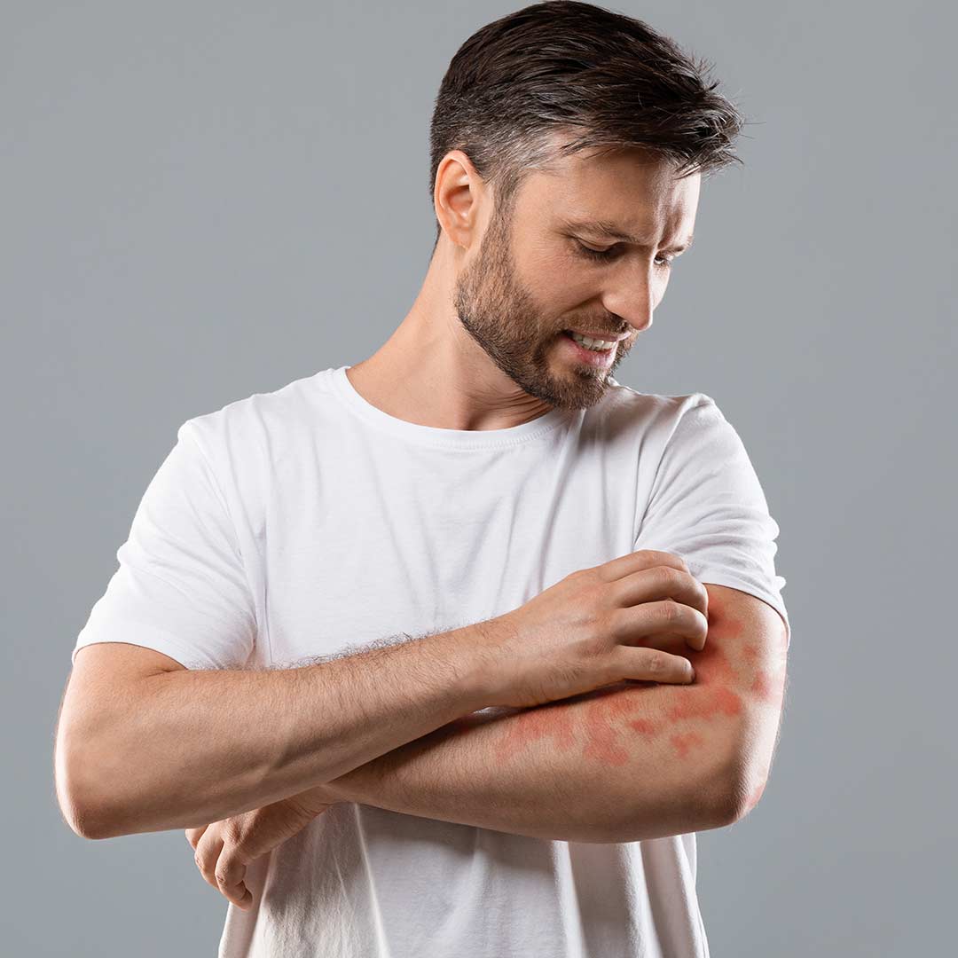 How Should I Prepare for Allergy Testing?