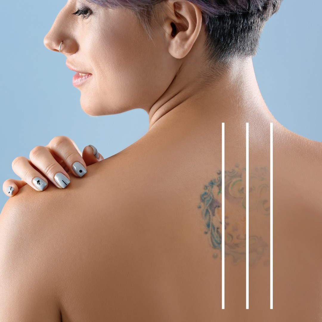 How Does Laser Tattoo Removal Work on Different Tattoo Colors?