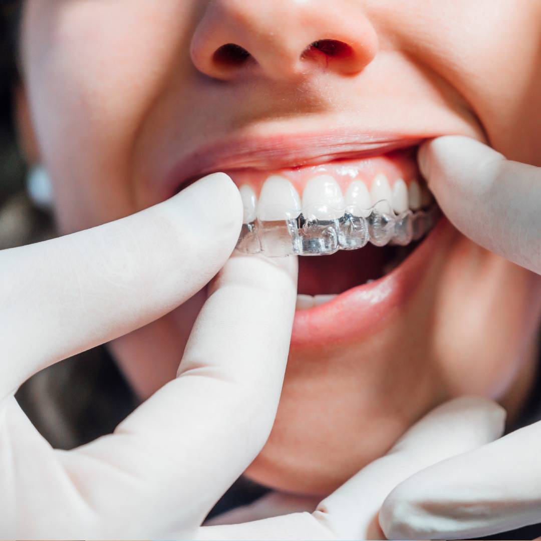What Is the Difference Between ClearCorrect and Invisalign?