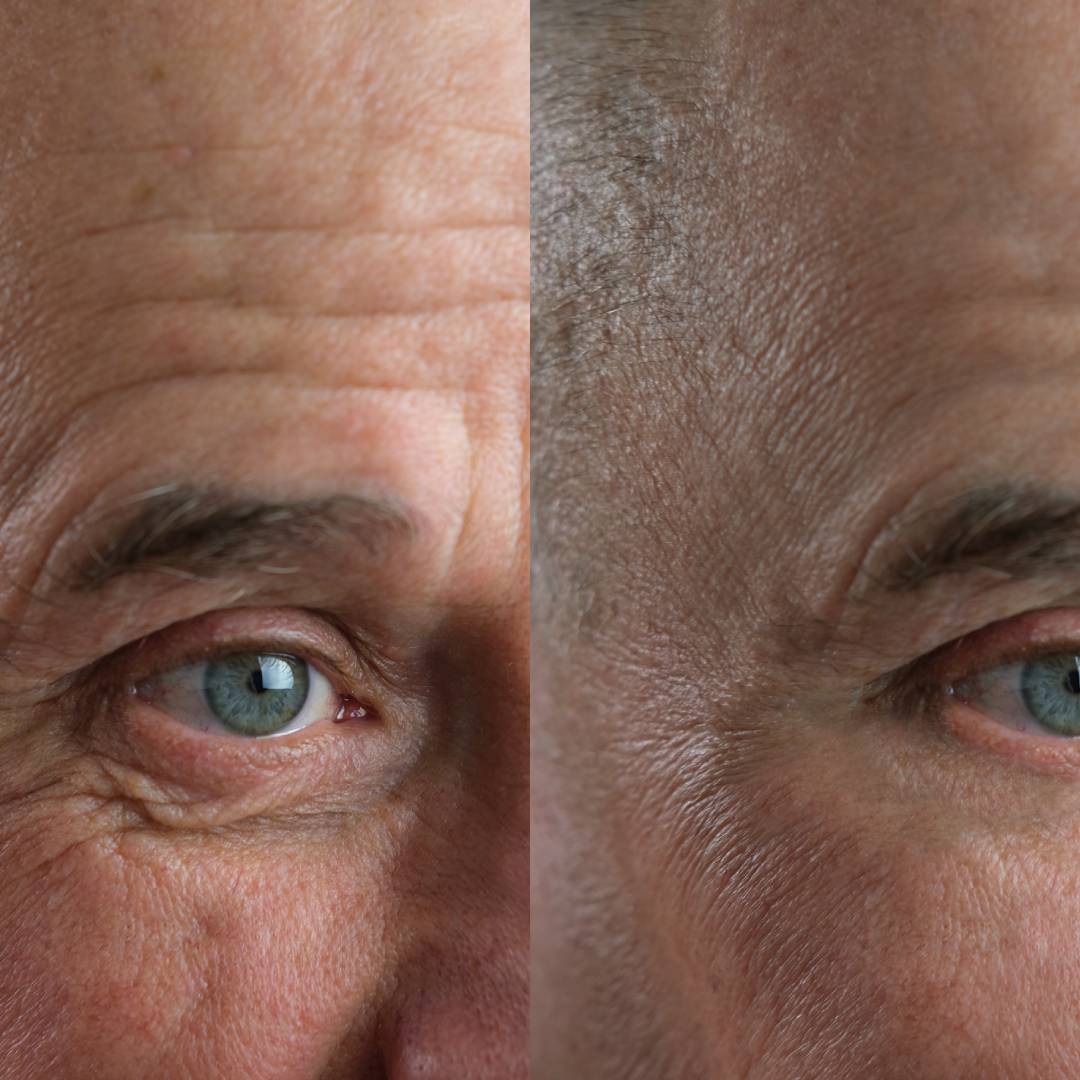 Can Laser Skin Resurfacing Treat Wrinkles and Fine Lines?
