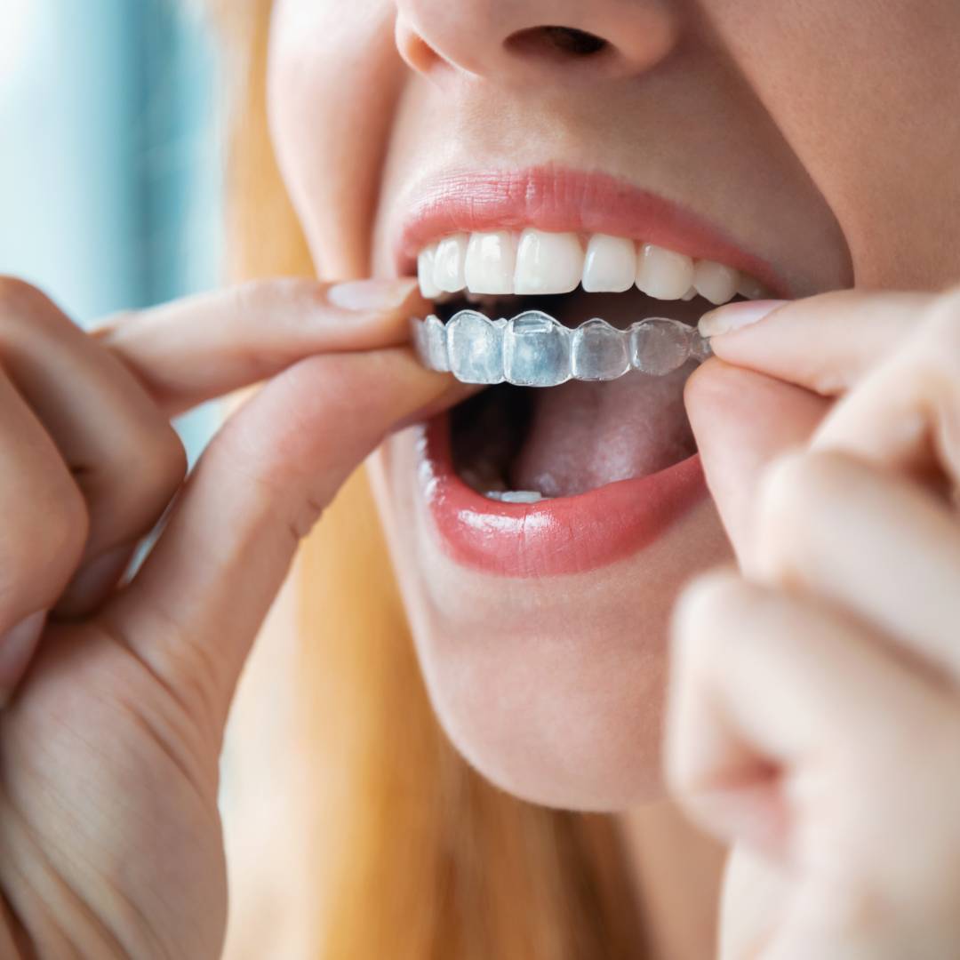 Can Invisalign Be Used to Treat Severe Crooked Teeth?