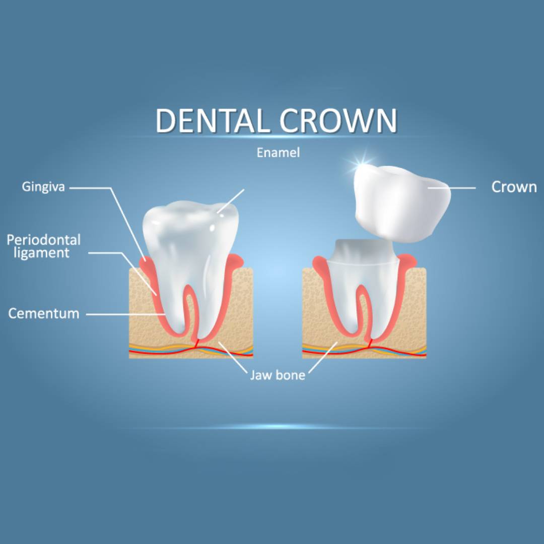 How Is a Tooth Prepared for Dental Crowns?