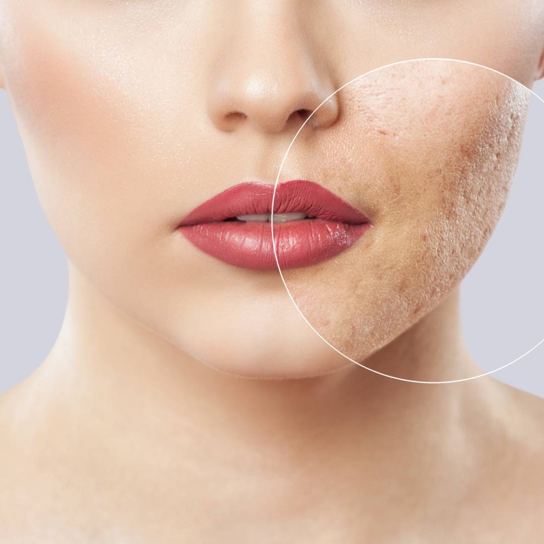 How Many Exosome Microneedling Sessions Are Needed for Optimal Results?