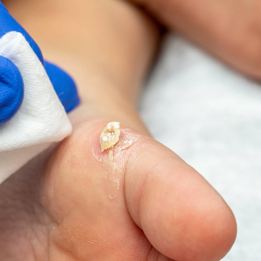 What Causes Calluses on Feet?