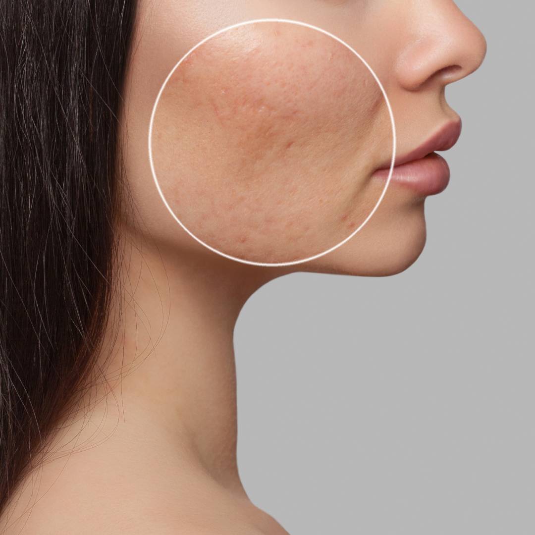 Can Acne & Acne Scars Lead to Long-Term Skin Damage?
