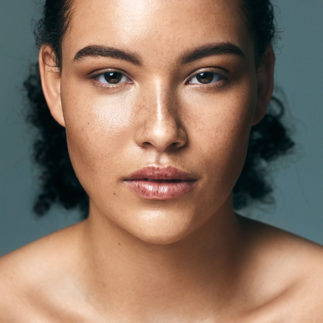 Can Diet Play a Role in Treating Melasma?