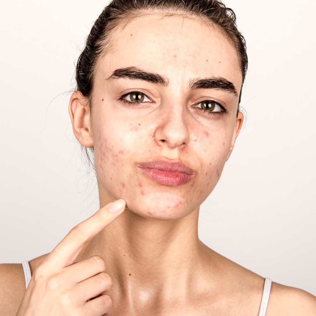 What Are the Most Common Myths About Acne and Acne Scars?