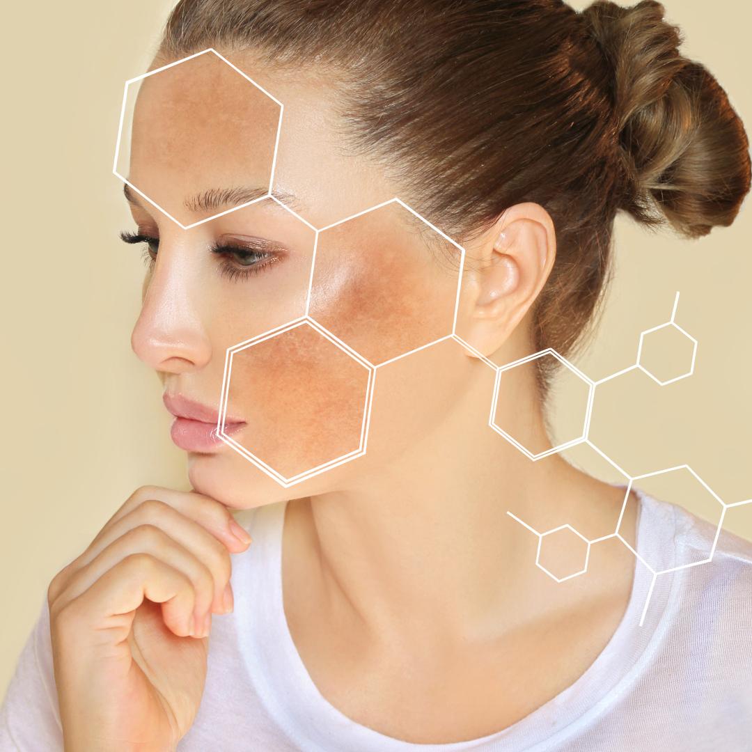 How Does Sun Exposure Affect Melasma?