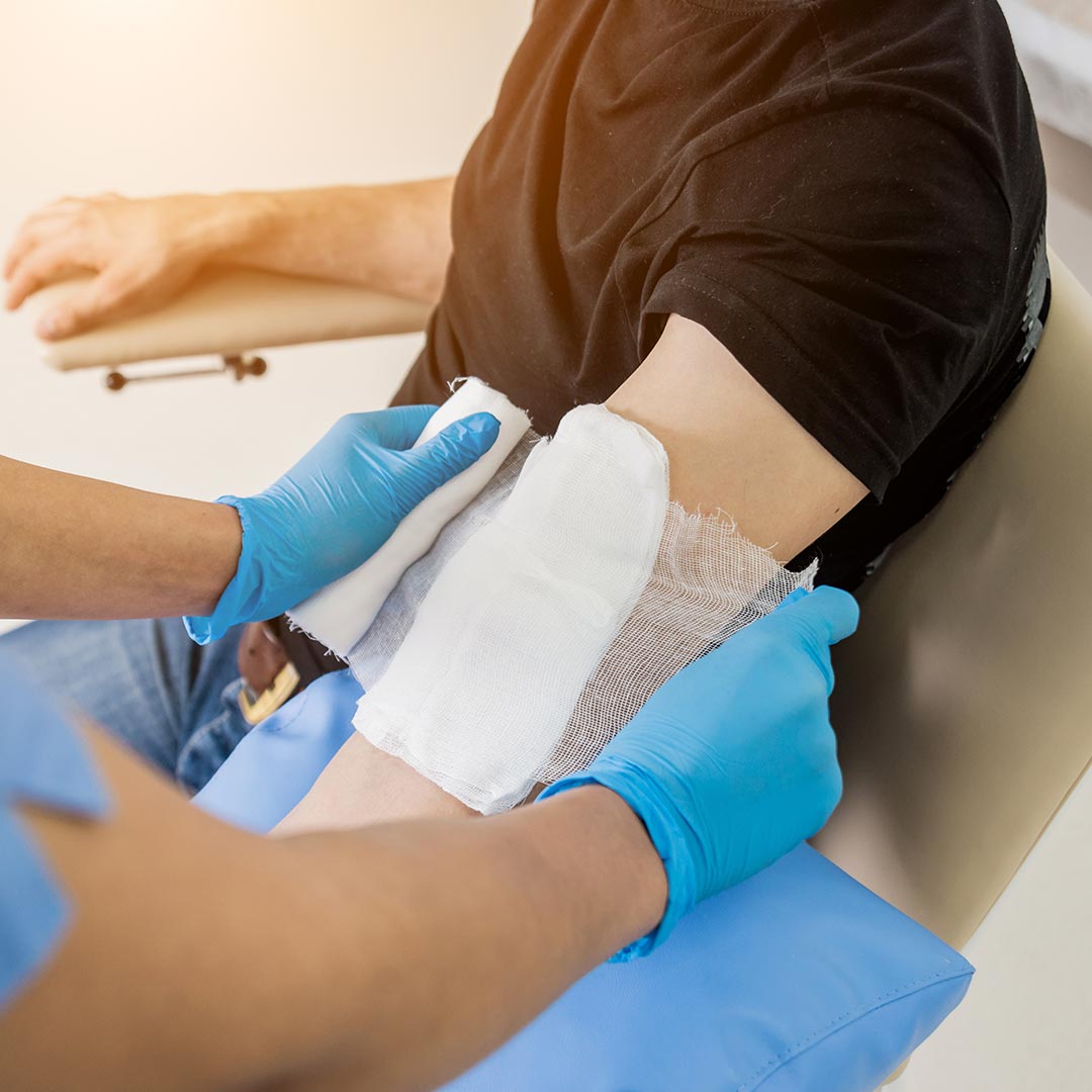 How Do I Know If I Need Professional Burns Treatment?