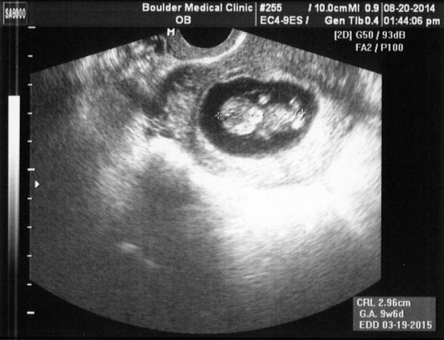 Ultrasound of Version 2.1 rc1 at 9 weeks, 6 days