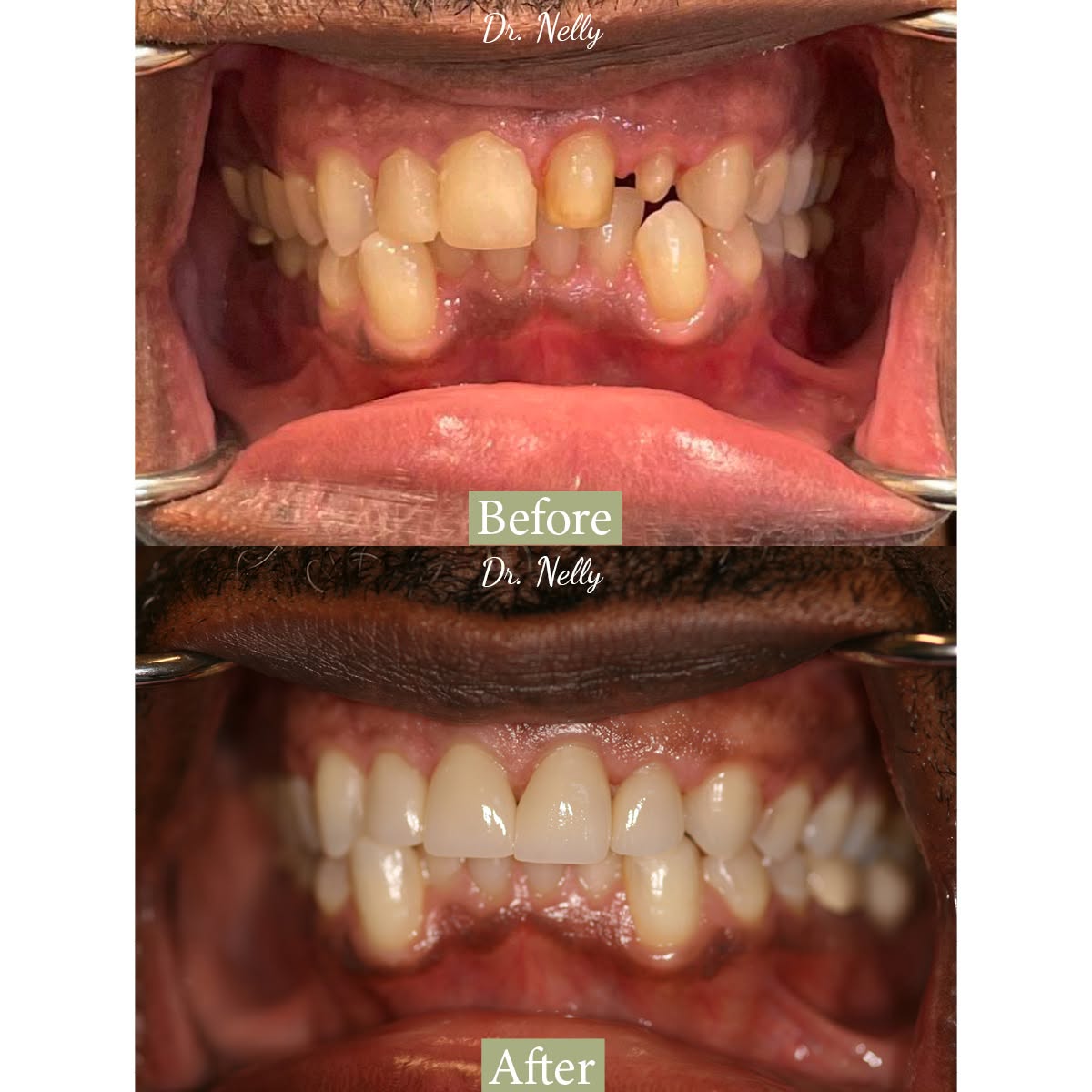 Before porcelain veneers: crowded and chipped teeth