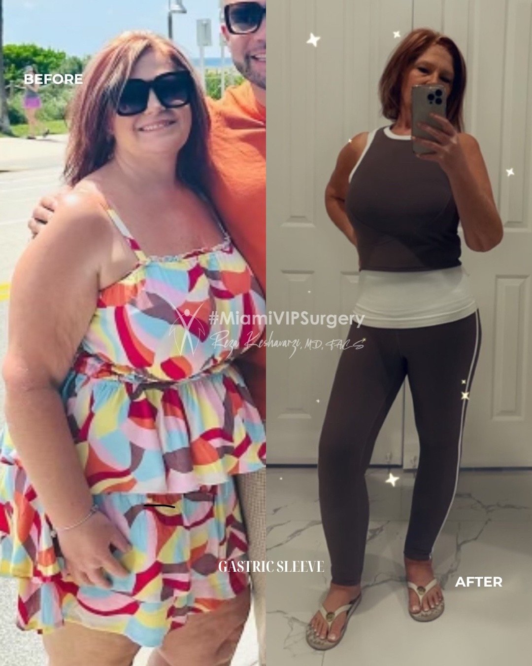 Before and after gastric sleeve surgery: a woman in a patterned sundress, then slimmer in a fitted top