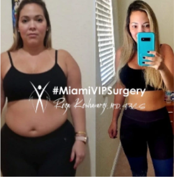 Before and after low BMI gastric sleeve: a woman's midsection in a black sports top, then visibly flatter in a mirror photo