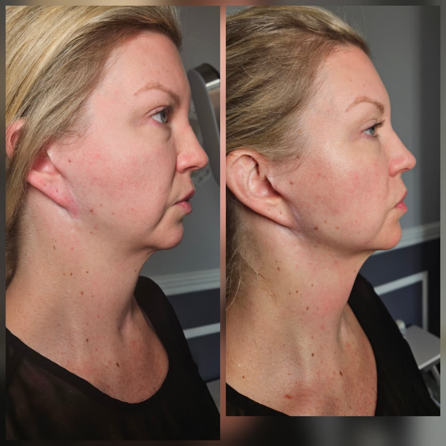 Side profile of a woman before and after a non-surgical necklift, showing a tighter line from chin to neck afterward