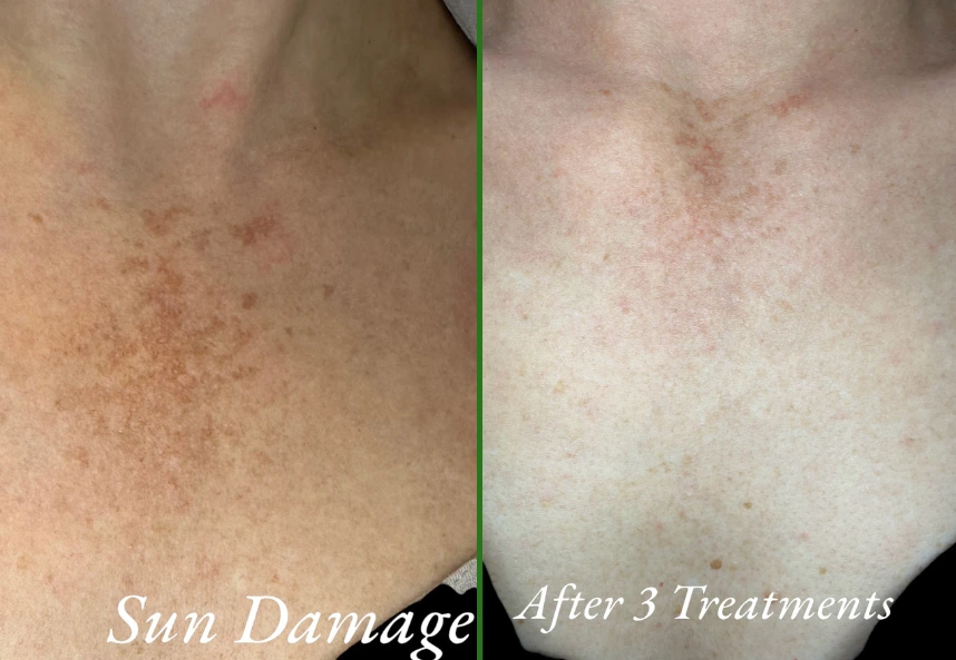 Before and after treatment of sun damage on the chest, showing fewer brown spots and a more even tone after three sessions