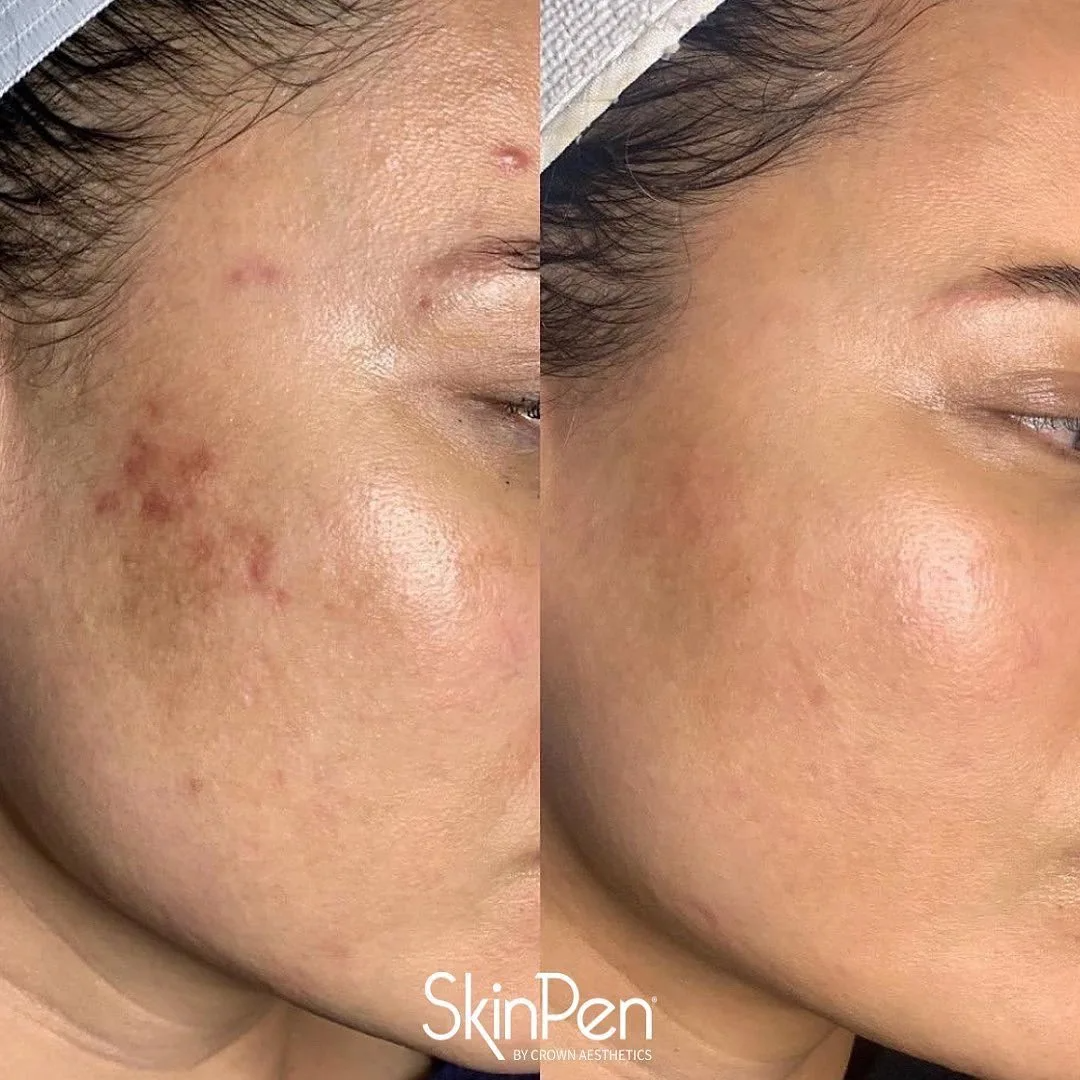 Before and after SkinPen microneedling on a cheek showing reduced acne scarring and a more even surface