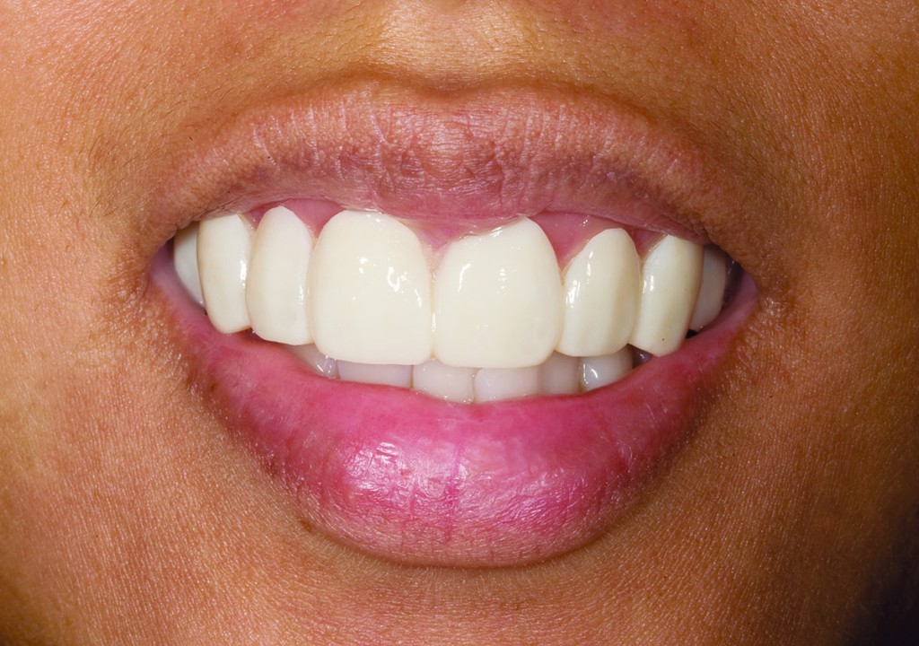 Close-up of a patient's smile with new porcelain veneers placed by Dr. Nelly Silva in Collegeville
