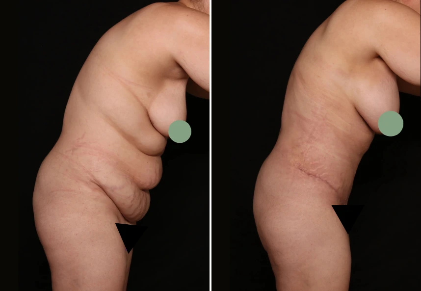 Before and after mommy makeover with tummy tuck
