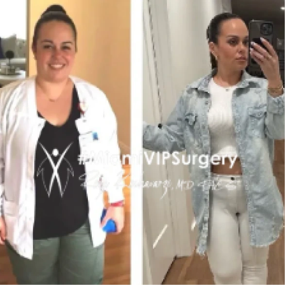 Gastric sleeve before and after of a woman in a white coat, then slimmer in white jeans and a denim jacket