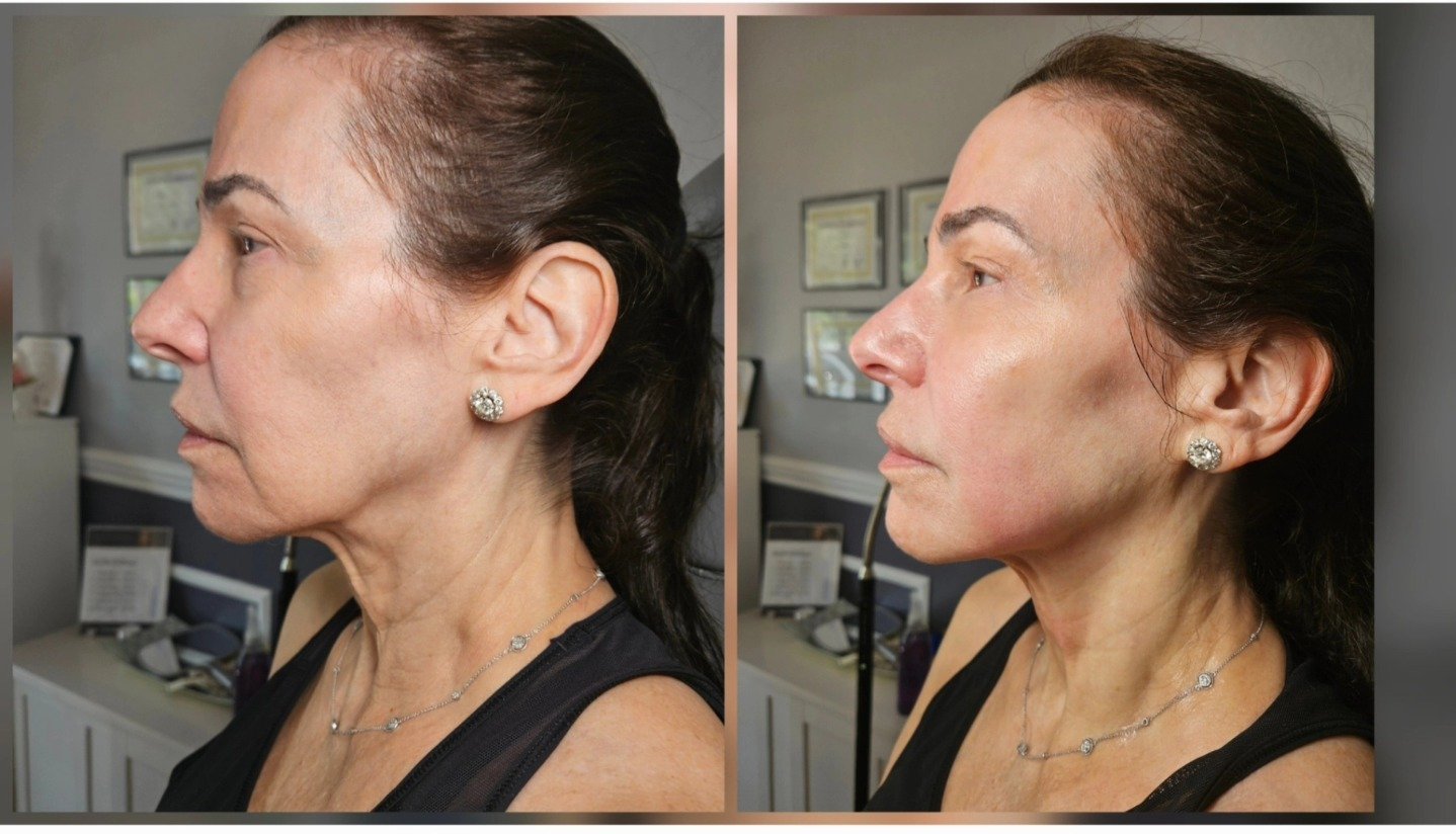 Non-surgical facelift before and after, side profile: lifted jowl and tighter neck on a dark-haired woman