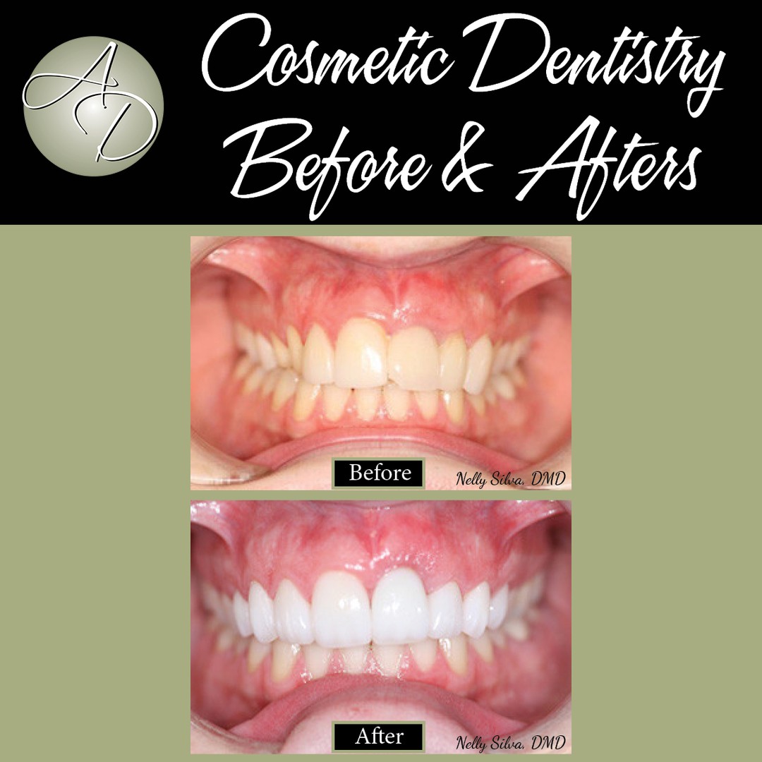 Before and after of yellowed front teeth changed to a bright, uniform smile with cosmetic dentistry