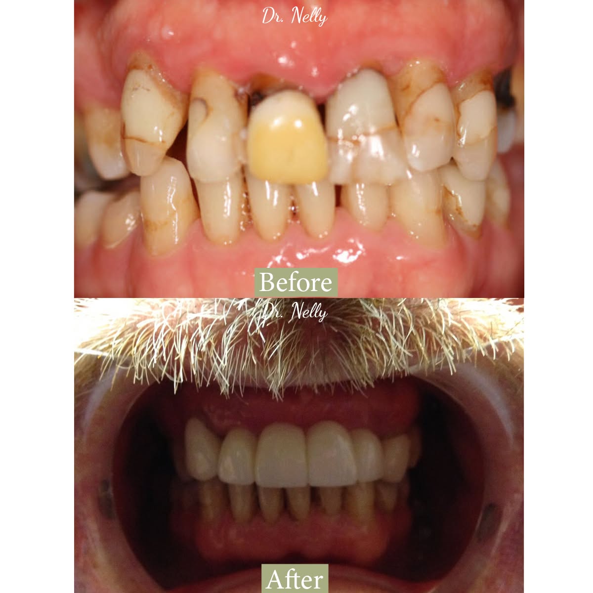 Before dental crowns: broken, decayed and discolored front teeth