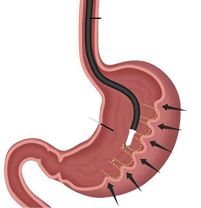 Illustration of an endoscope placing a row of sutures inside the stomach to fold it into a narrower sleeve during ESG