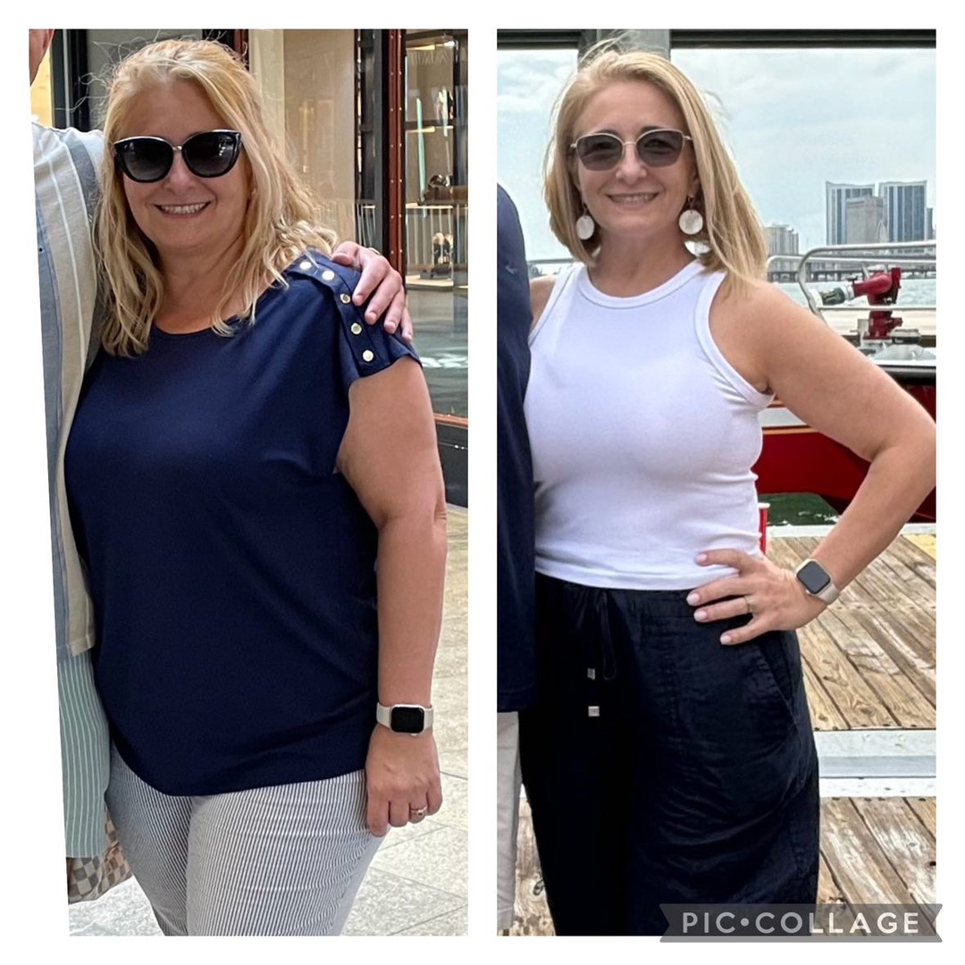Before and after photos of a female patient after gastric sleeve surgery