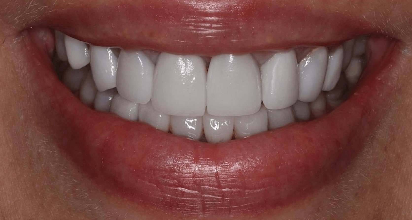 Extreme close-up of a patient's smile showing bright, evenly shaped white teeth, likely a dental cosmetic result