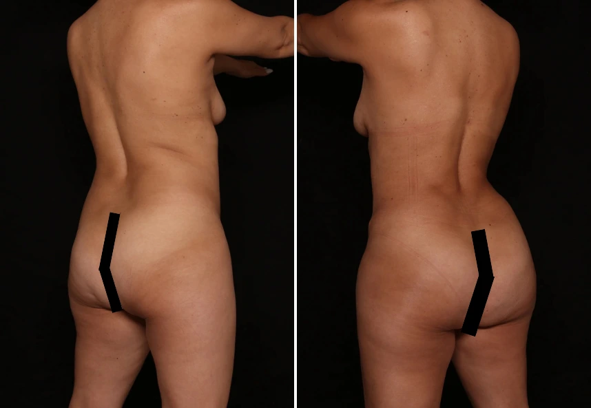 Before and after bra roll liposuction