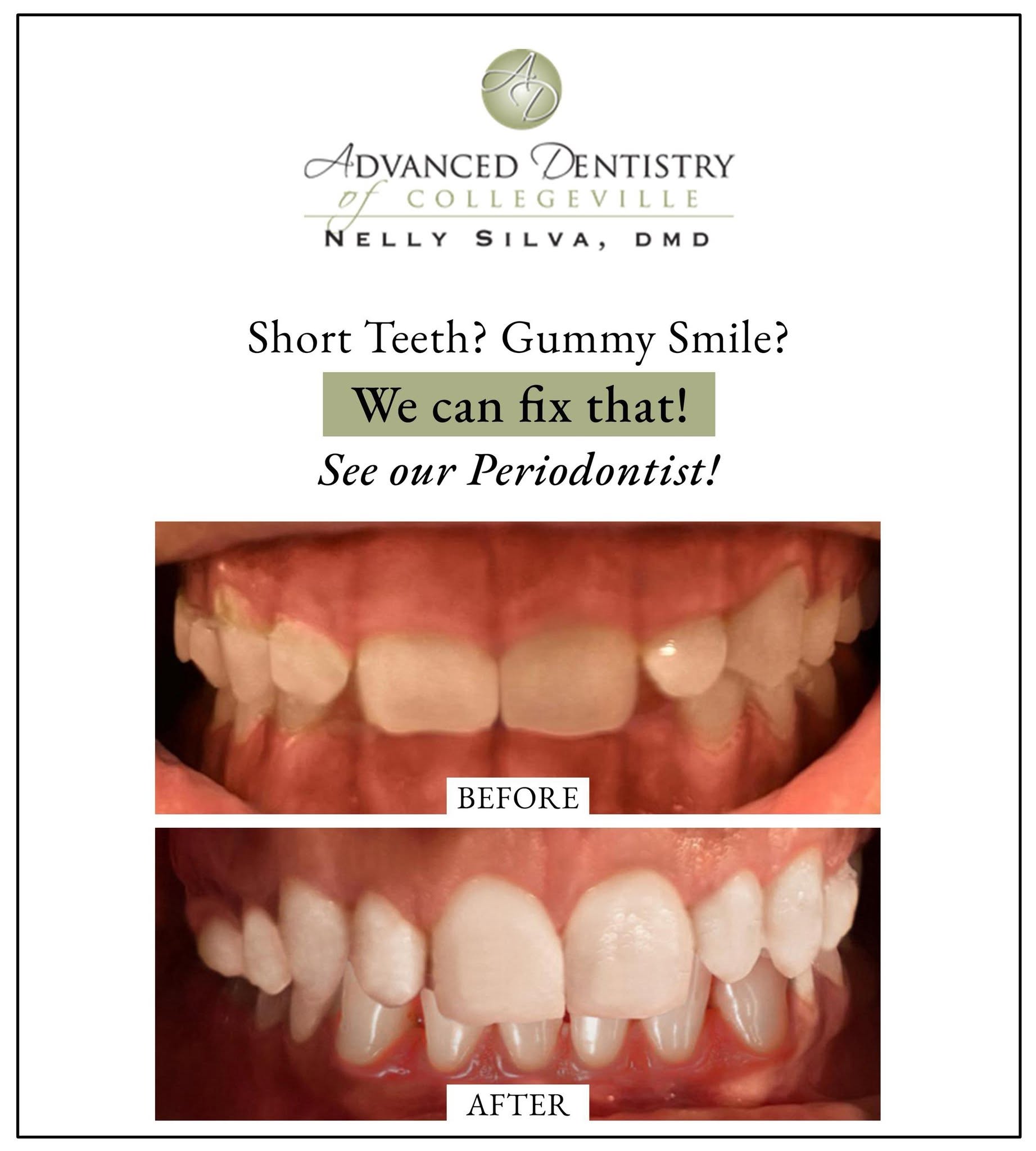 Before crown lengthening: short front teeth with excess gum tissue