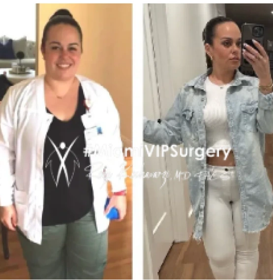 Before and after low BMI gastric sleeve: a woman in a white coat, then slimmer in a denim jacket
