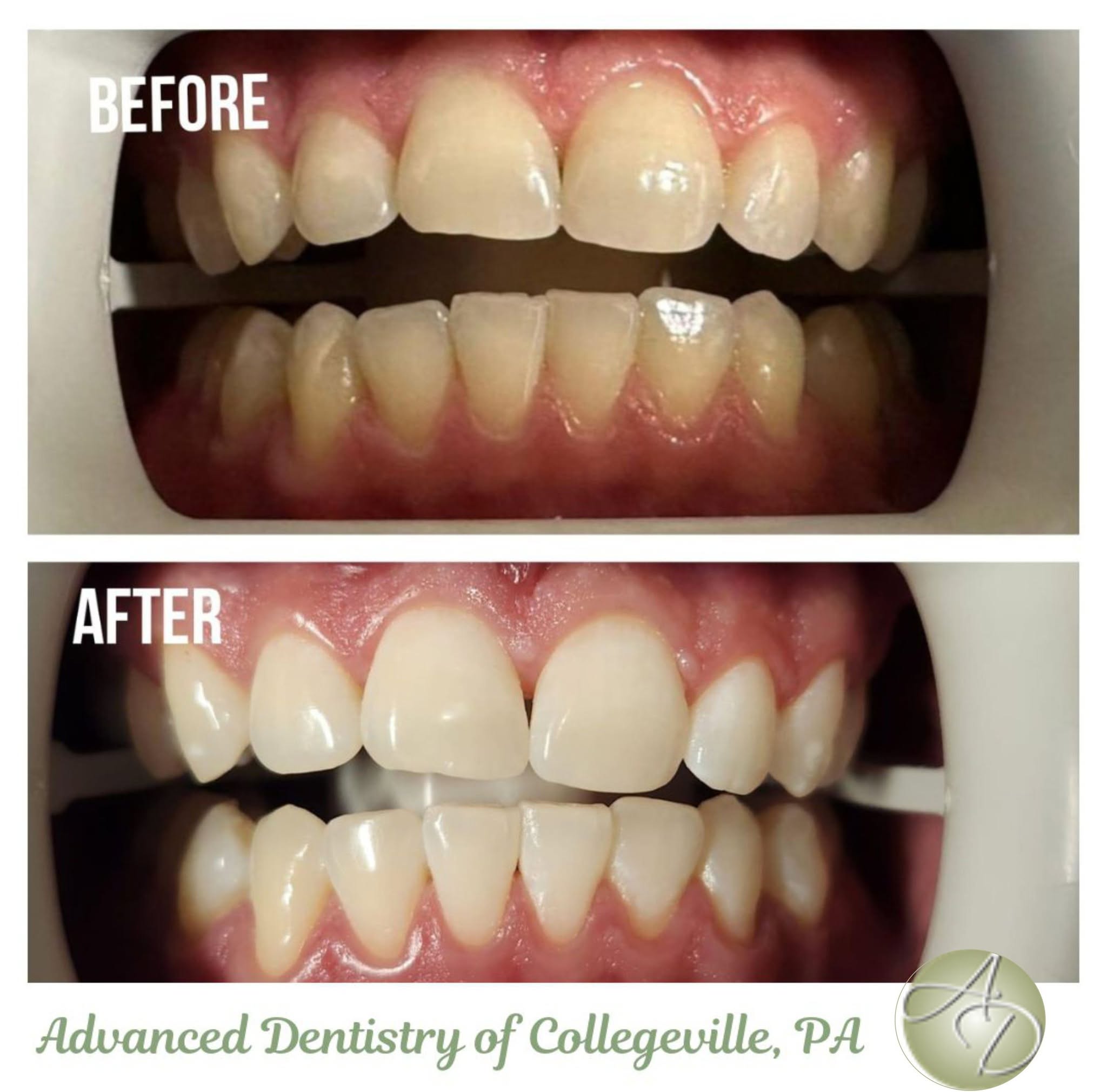 Before and after of a patient's teeth after whitening and alignment, before on top and after below