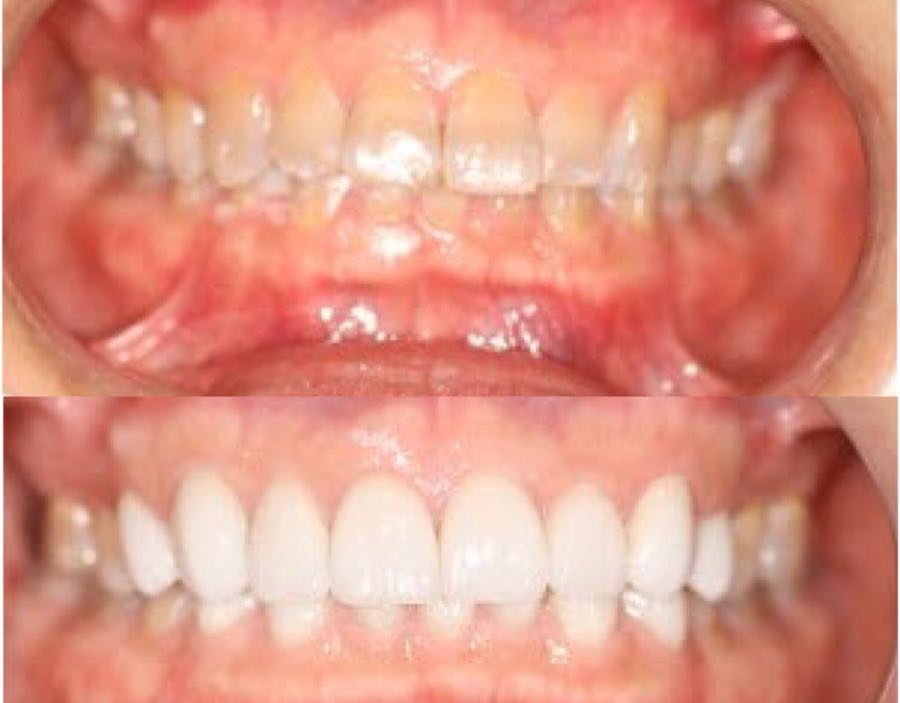 Before porcelain veneers: crooked, discolored upper front teeth