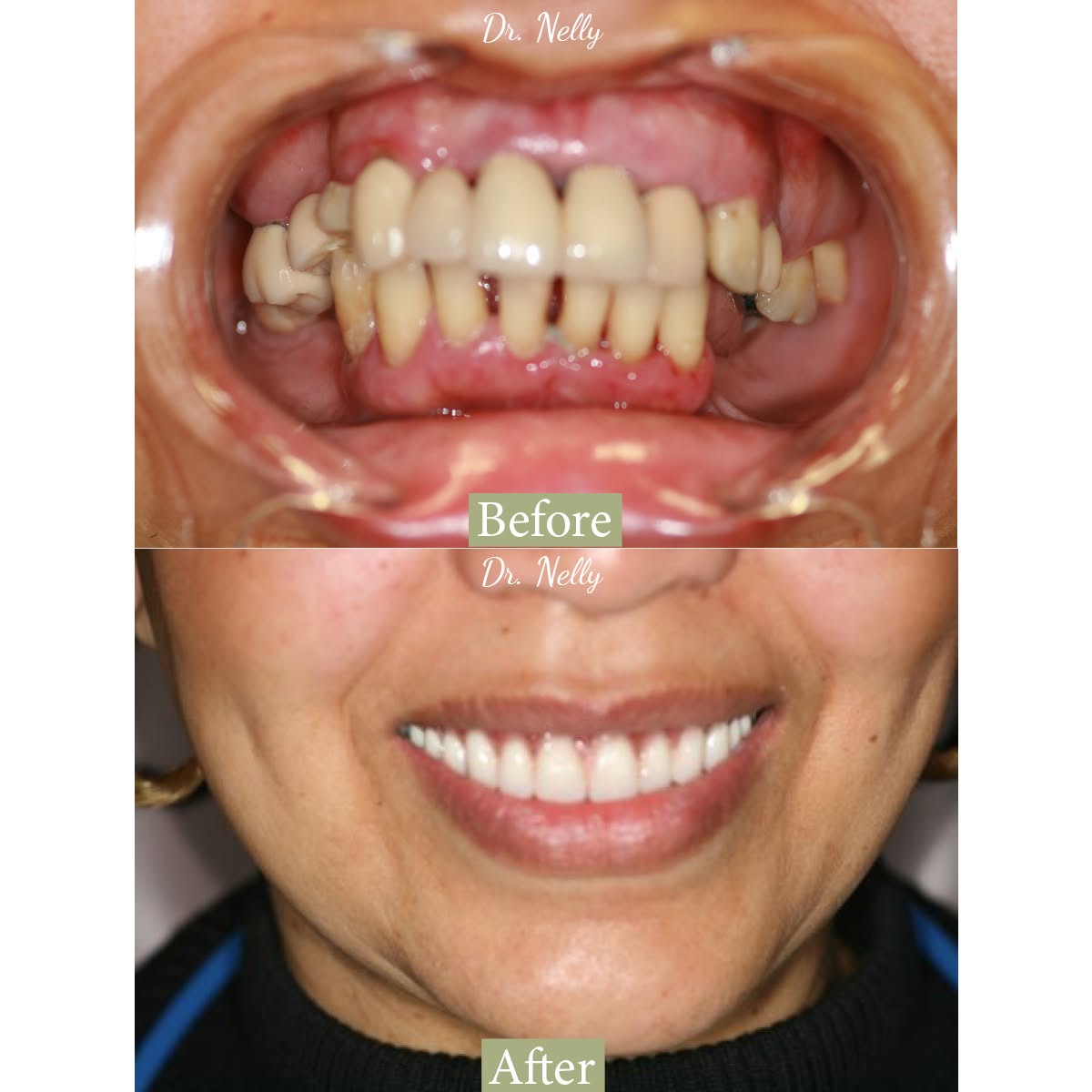 Before and after of a smile with decayed, crowded teeth restored to a bright, even smile