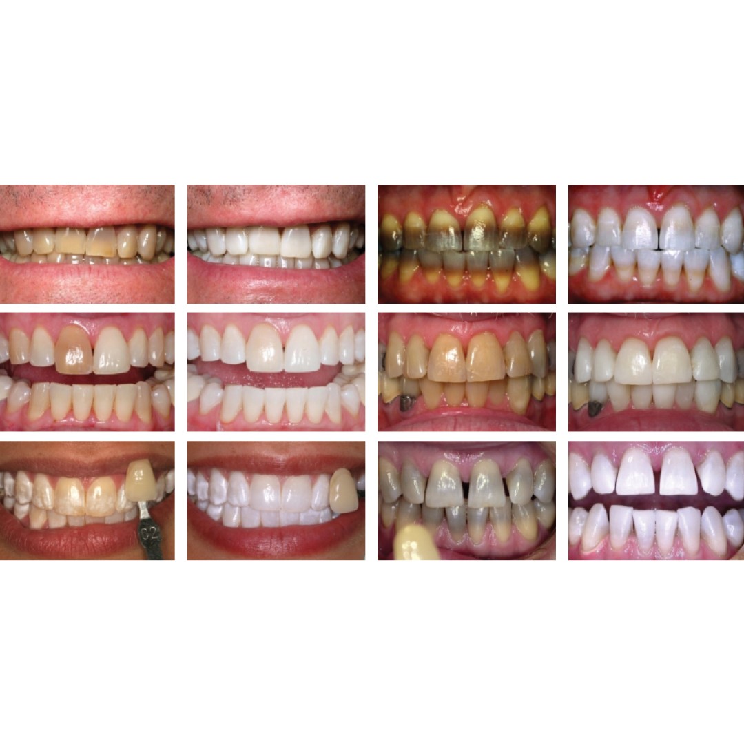 Before KöR whitening: yellowed and uneven upper front teeth