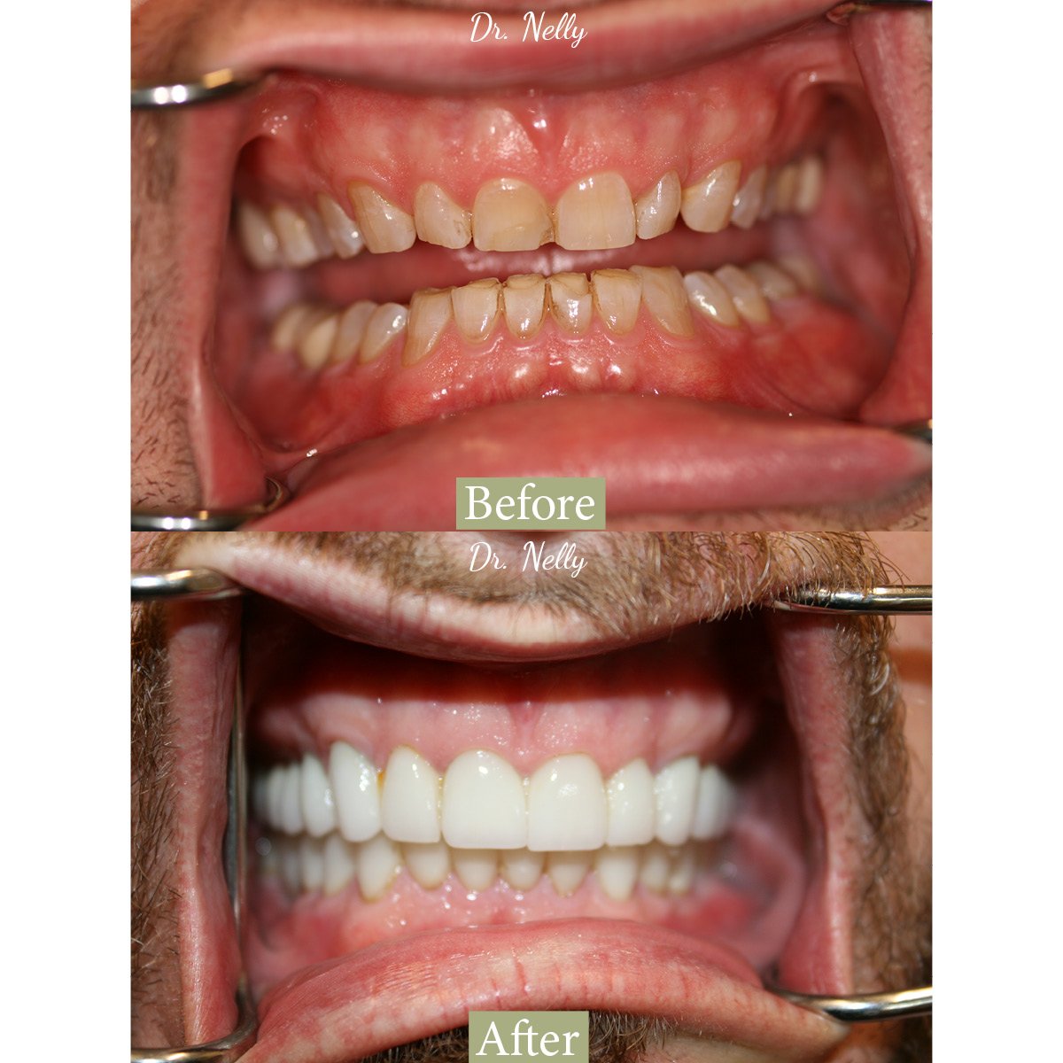 Before porcelain veneers: worn and discolored front teeth