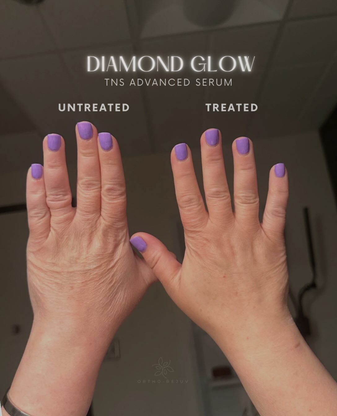A patient's two hands side by side: the untreated left hand shows fine crepey lines, the right hand treated with Diamond Glow looks smoother