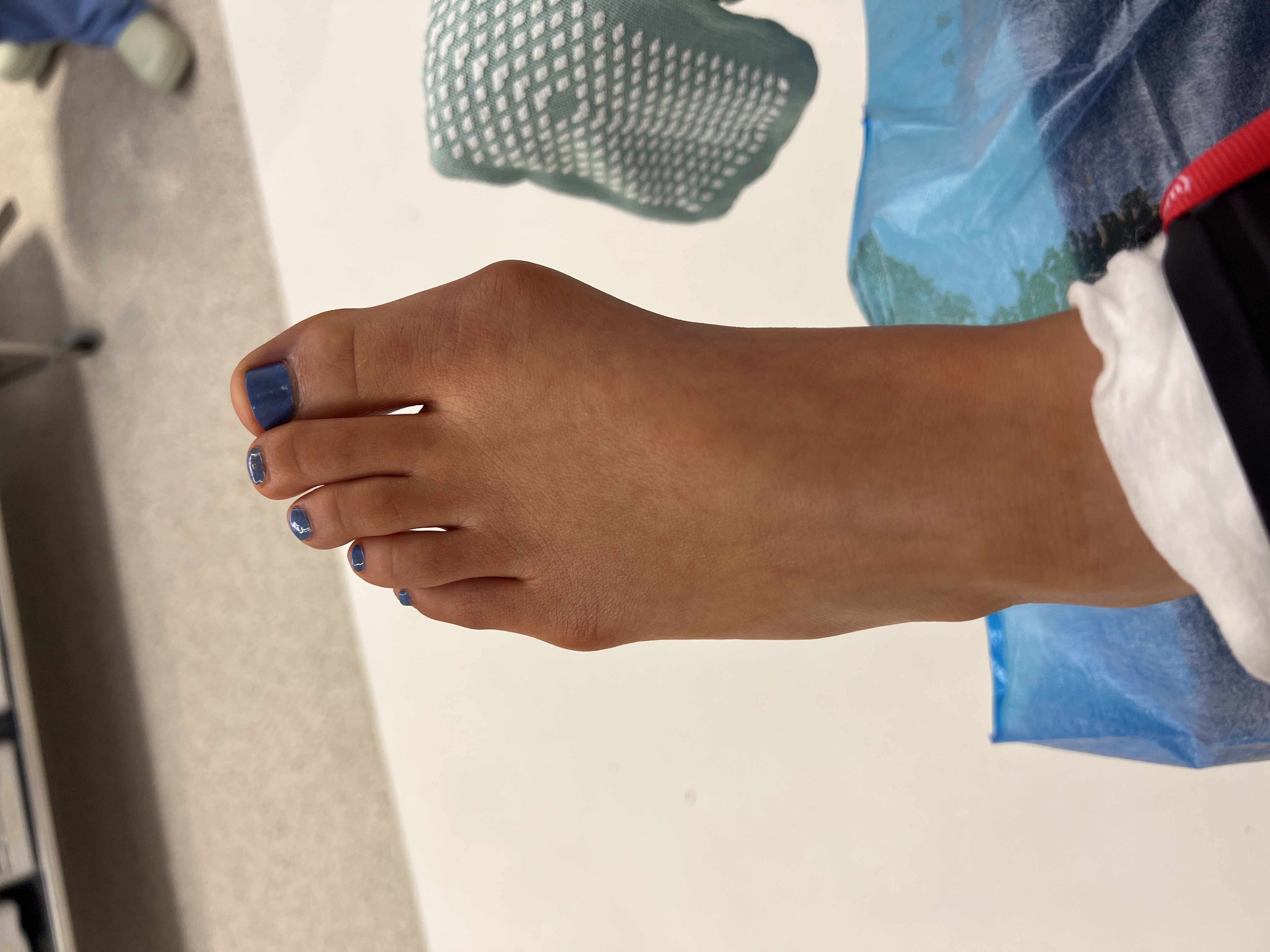 Patient's foot with a bunion at the base of the big toe, photographed during a podiatry visit