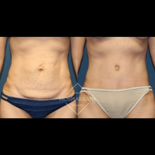 Before and after tummy tuck