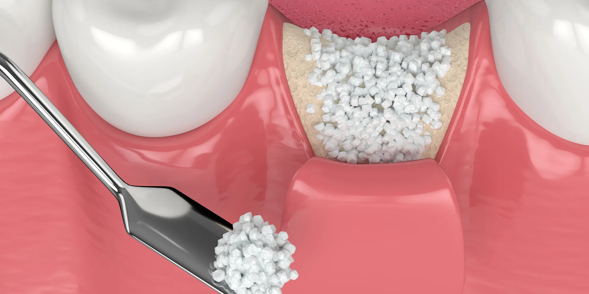 Illustration of bone graft granules placed into an empty tooth socket to preserve bone after an extraction