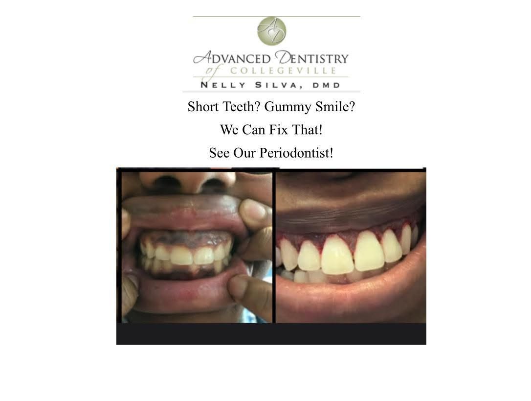Before gum reshaping: short upper teeth with heavy gum coverage
