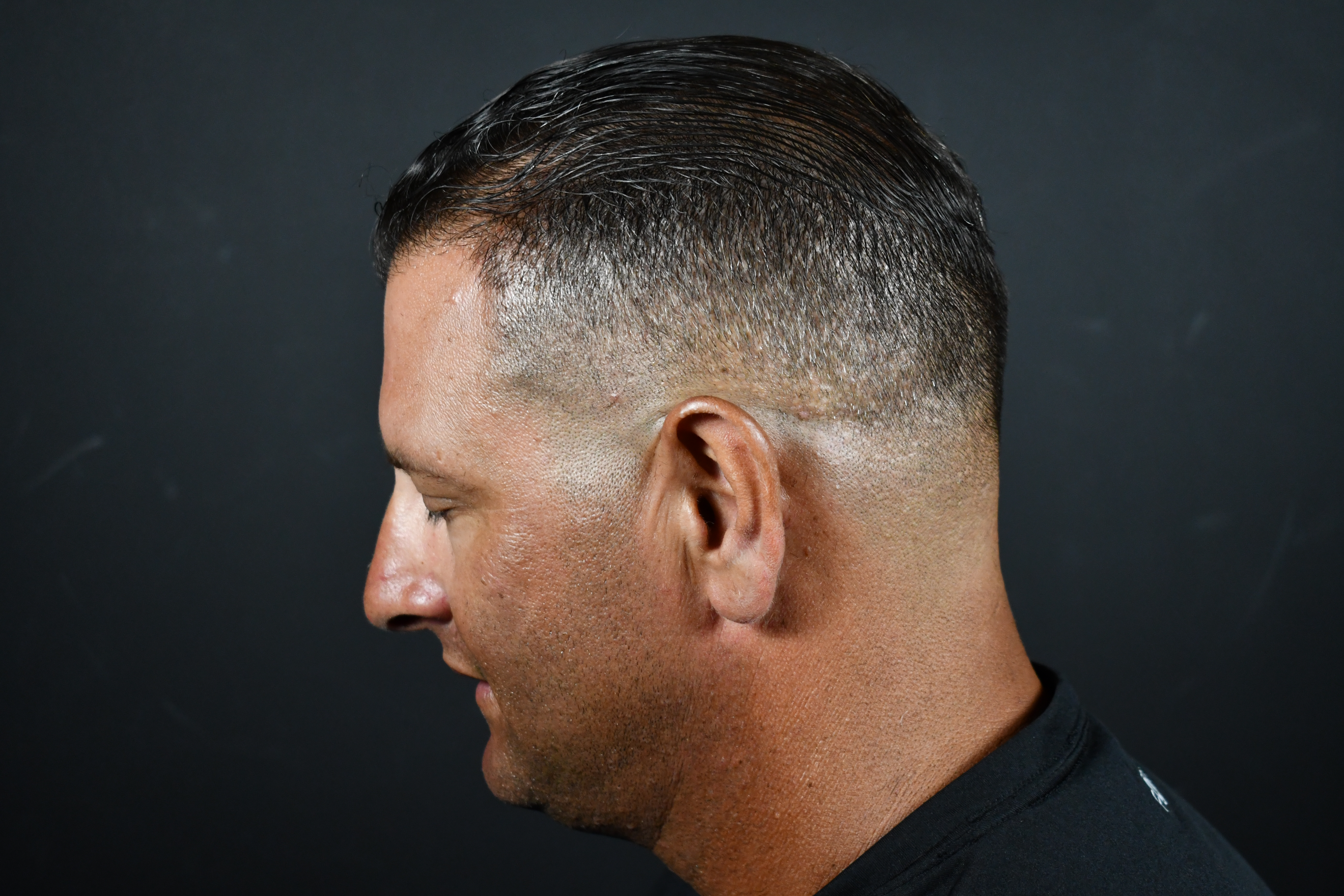 Profile view of a man's short haircut and hairline, likely showing a hair restoration result