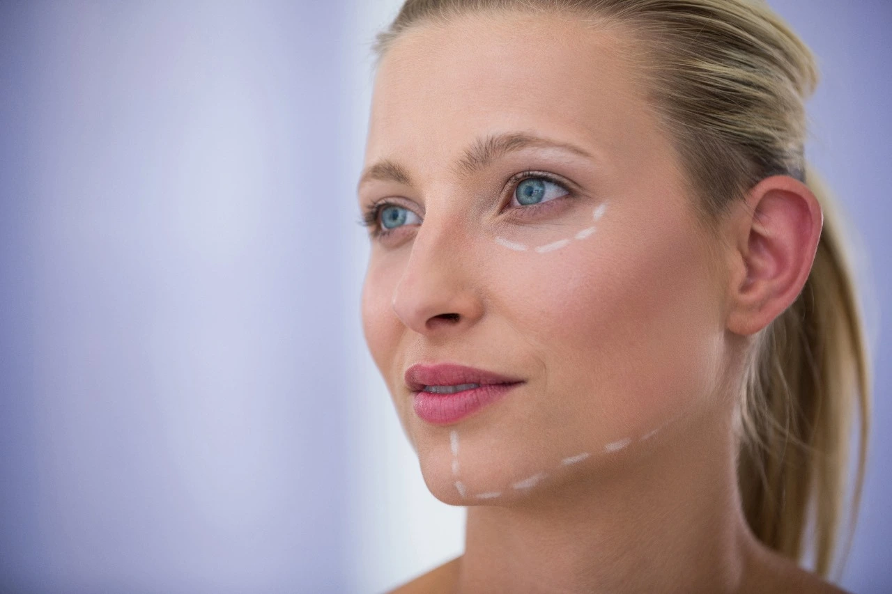 Close-up of a young woman's face with dotted surgical markings along the jawline and under the eye, illustrating facelift inc